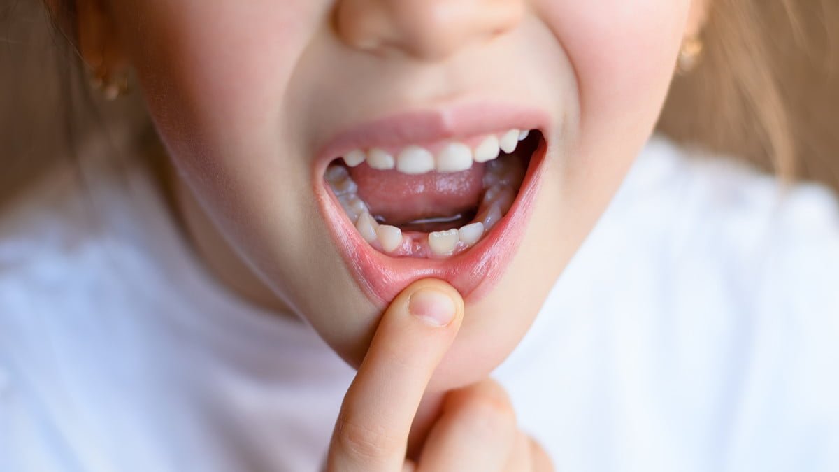 Cara Agar Gigi Anak Cepat Tanggal, Intip Yuk!